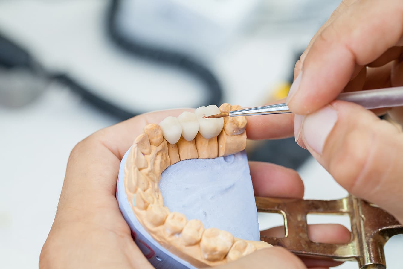 Dr. Hugo Manrique, DMD, sculpting a dental bridge a everlasting dental