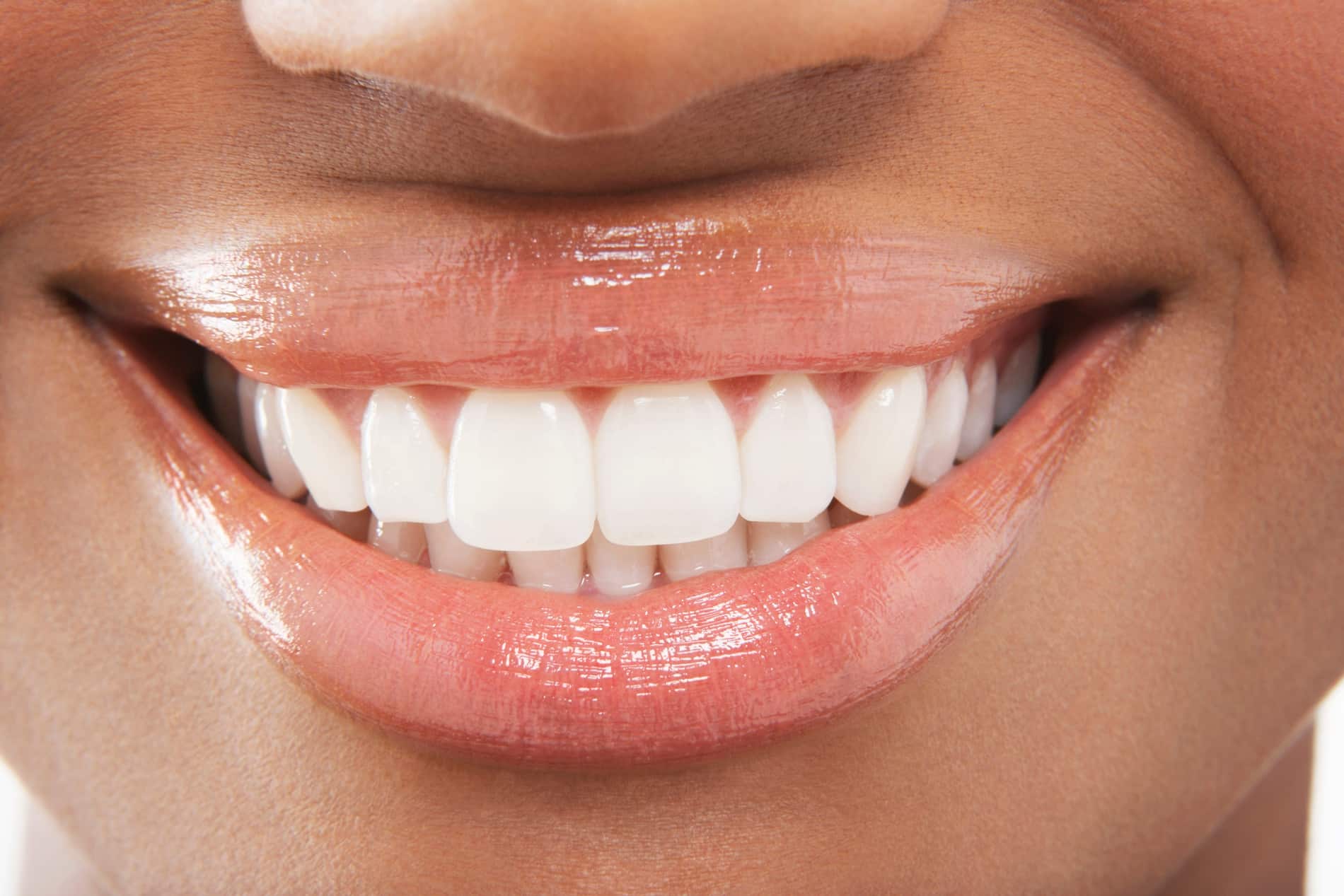 Woman with perfect teeth after cavity fillings with Everlasting Dental Care